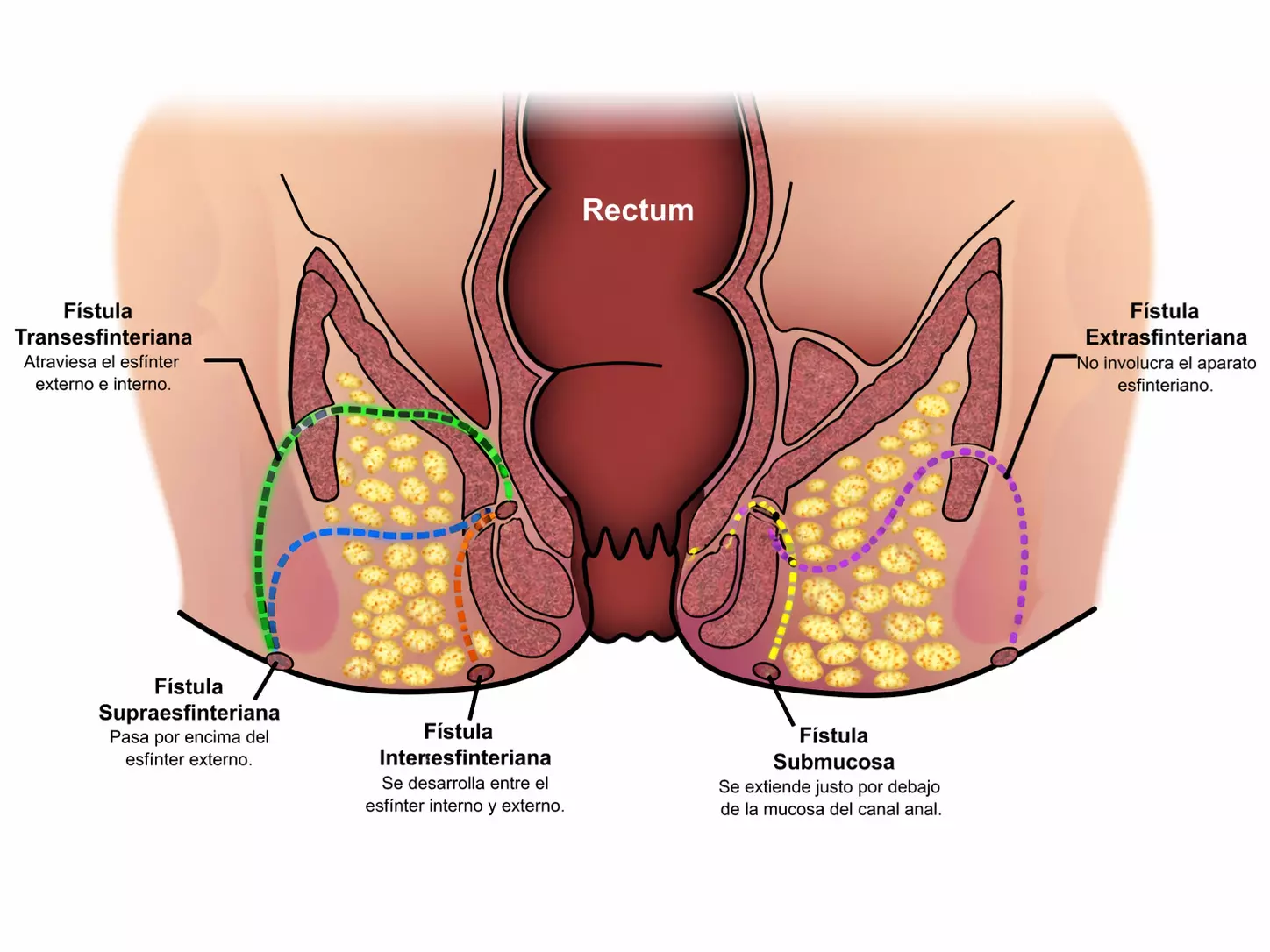 Fístulas y sus tratamientos